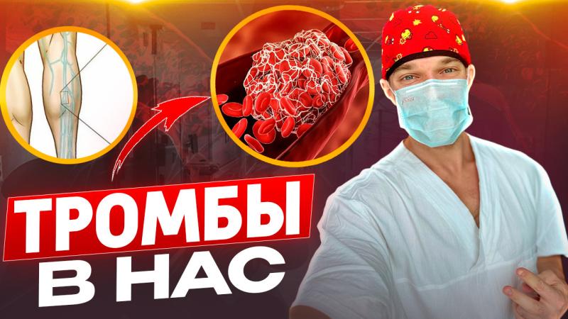 ТРОМБЫ в наших сосудах, варикоз, бляшки и тромбозы.